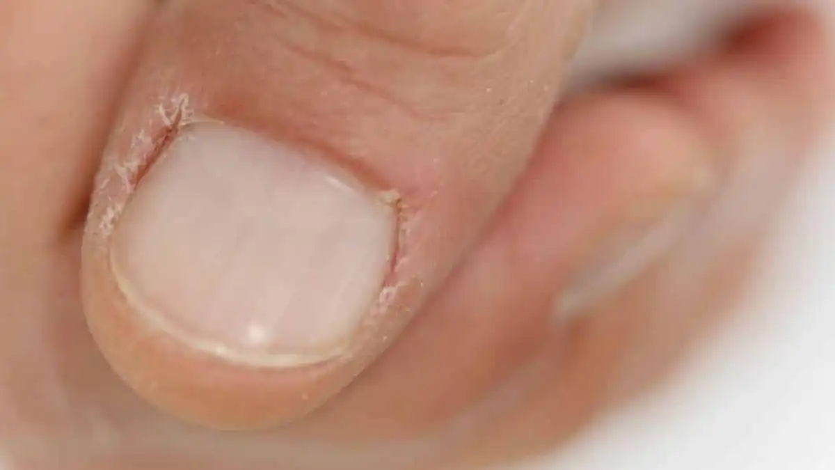 Cutícula ressecada, por que tem pelinhas no canto das unhas?