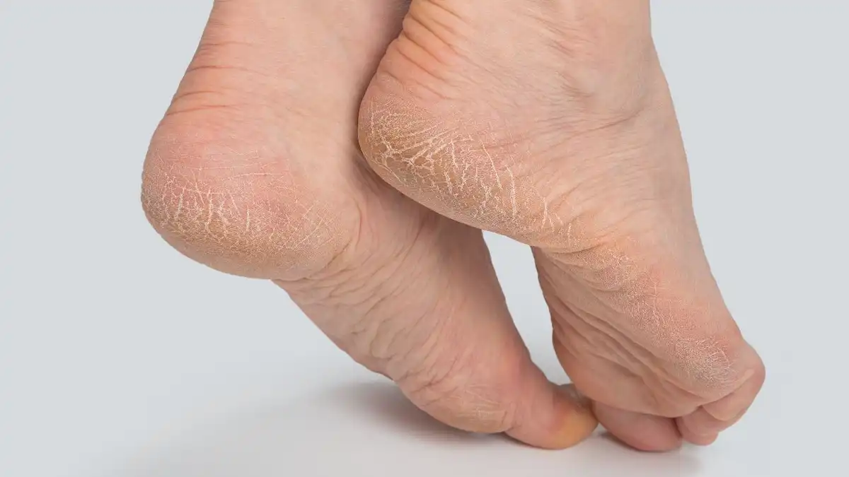 O que causa rachaduras nos pés e como tratar?