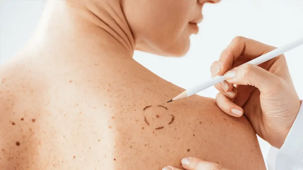 O que causa manchas escuras na pele das mulheres?